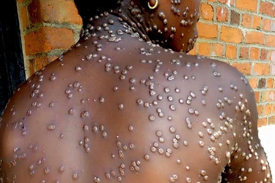Ministério da Saúde confirma segundo caso de varíola dos macacos em Luanda