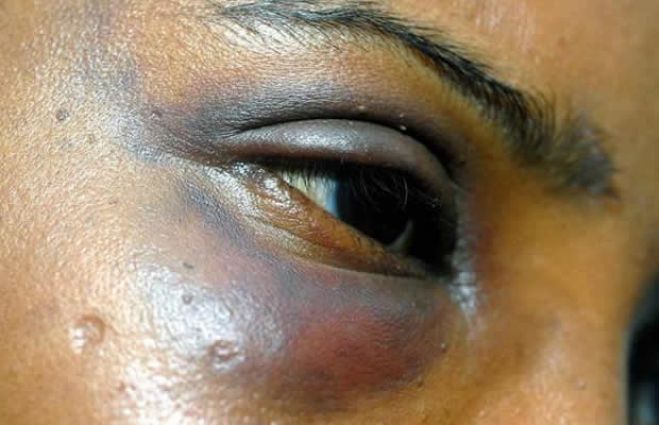 Violência doméstica em Angola está a tornar-se num problema de saúde pública - ministra
